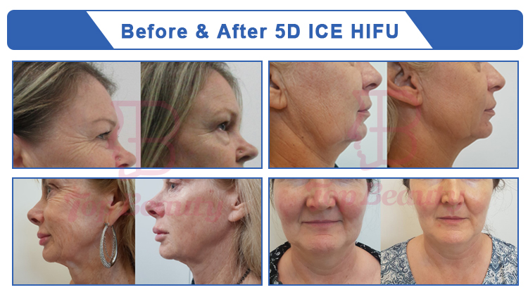 5D Skin Care Portable HIFU Facial Machine Cryo Anti Wrinkle Equipment