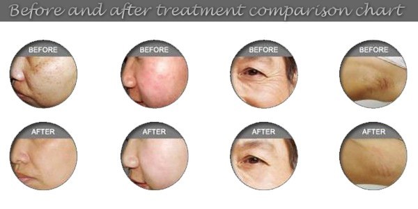 ipl portable designed,ipl men hair remover,ipl machine laser hair removal