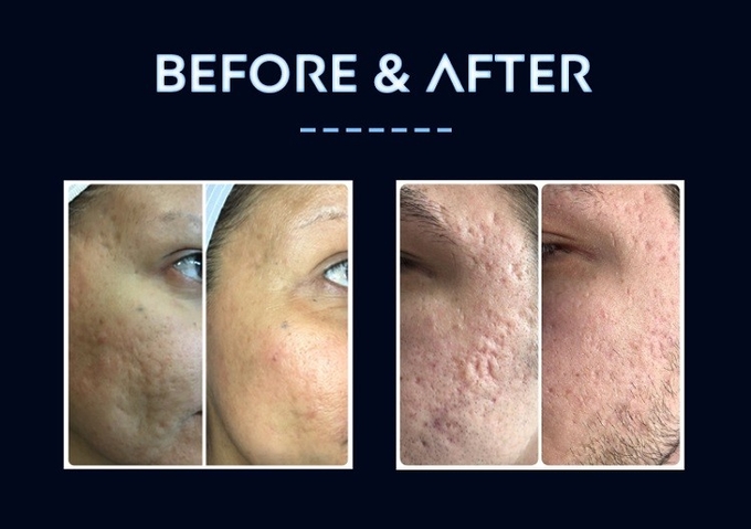 Radio Frequency Microneedling Machine , Thermolift Machine For Spa Salon