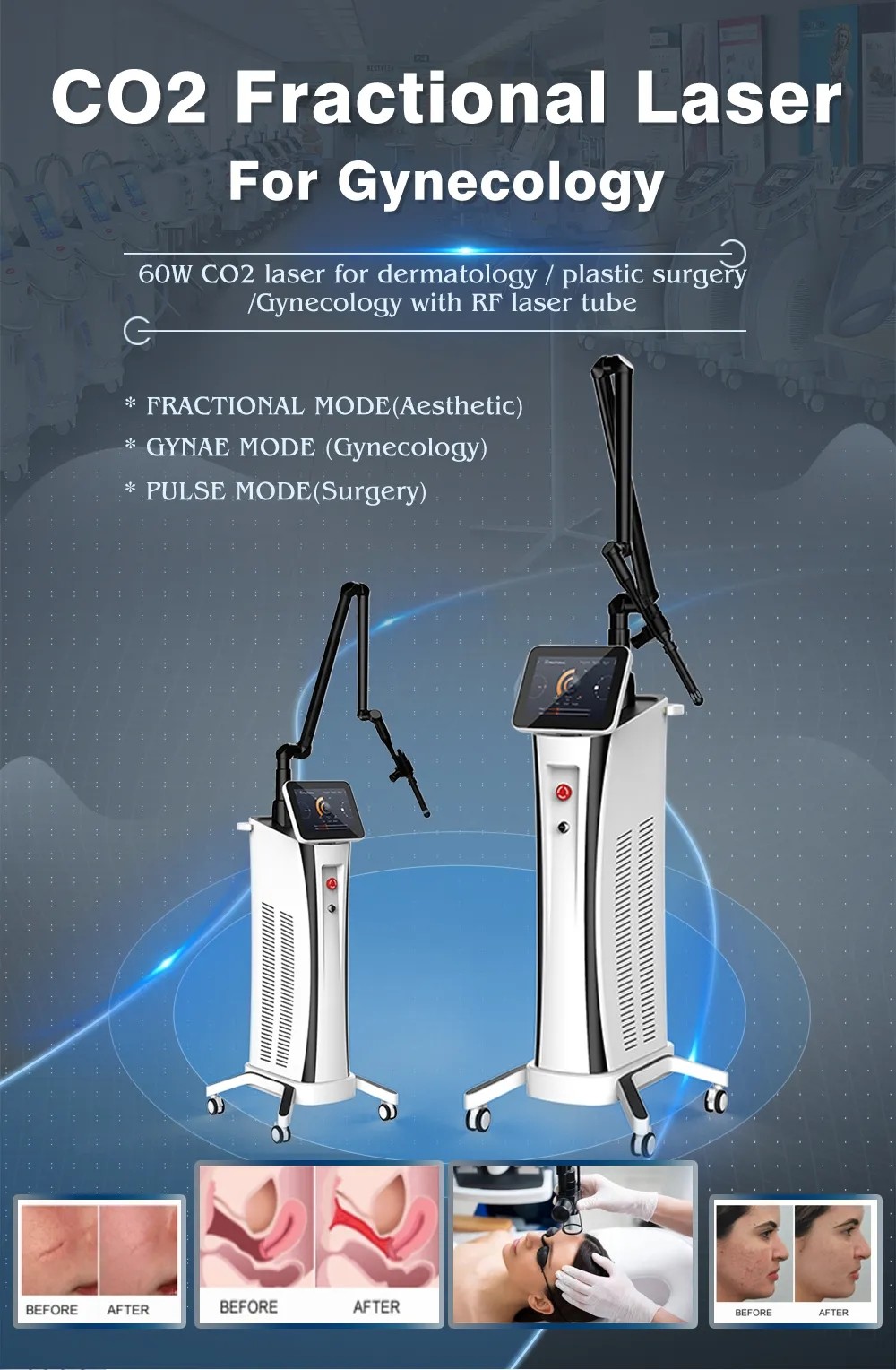 60W Fractional Treatment Co2 Laser Skin Rejuvenation Machine 10600nm