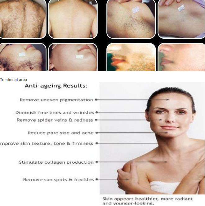 high quality hair removal shr laser