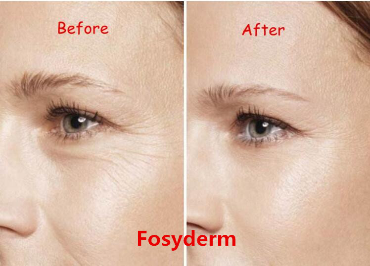2ml Fine Hyaluronic Acid Dermal Filler , Injectable Fillers For The Face