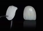 Cosmetic Dentistry EMAX Porcelain Veneers for Beautiful Dental Restorations
