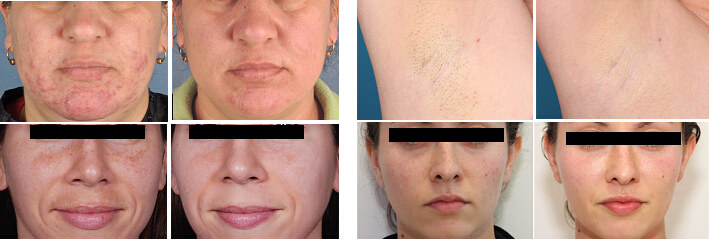 portable ipl hair removal and collagen stimulation skin firming machine