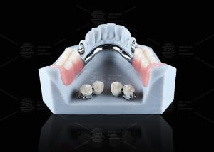 China Titanium Dental Implant Ball Attachments Comfortable Secure Denture Retention wholesale