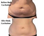 Ultrasound 4D Cavitation Slimming Machine Vacuum Body Cellulite Removal