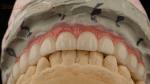 Hybrid Titanium Screw Retained Dental Implant Crown All On 4 Dental Implant