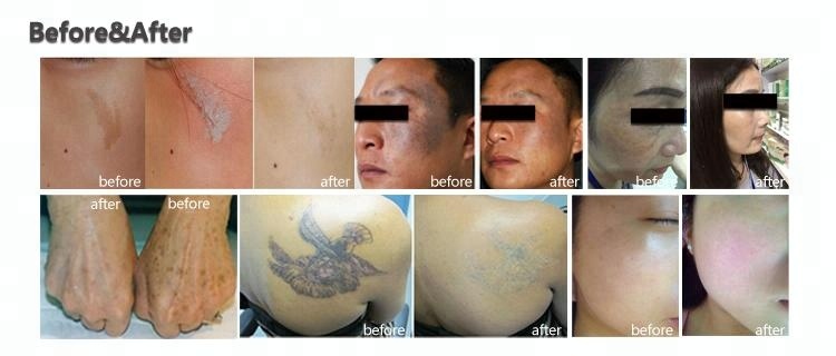 Vertical Beauty Picosecond Laser Machine Pigmentation Removal Laser Machine