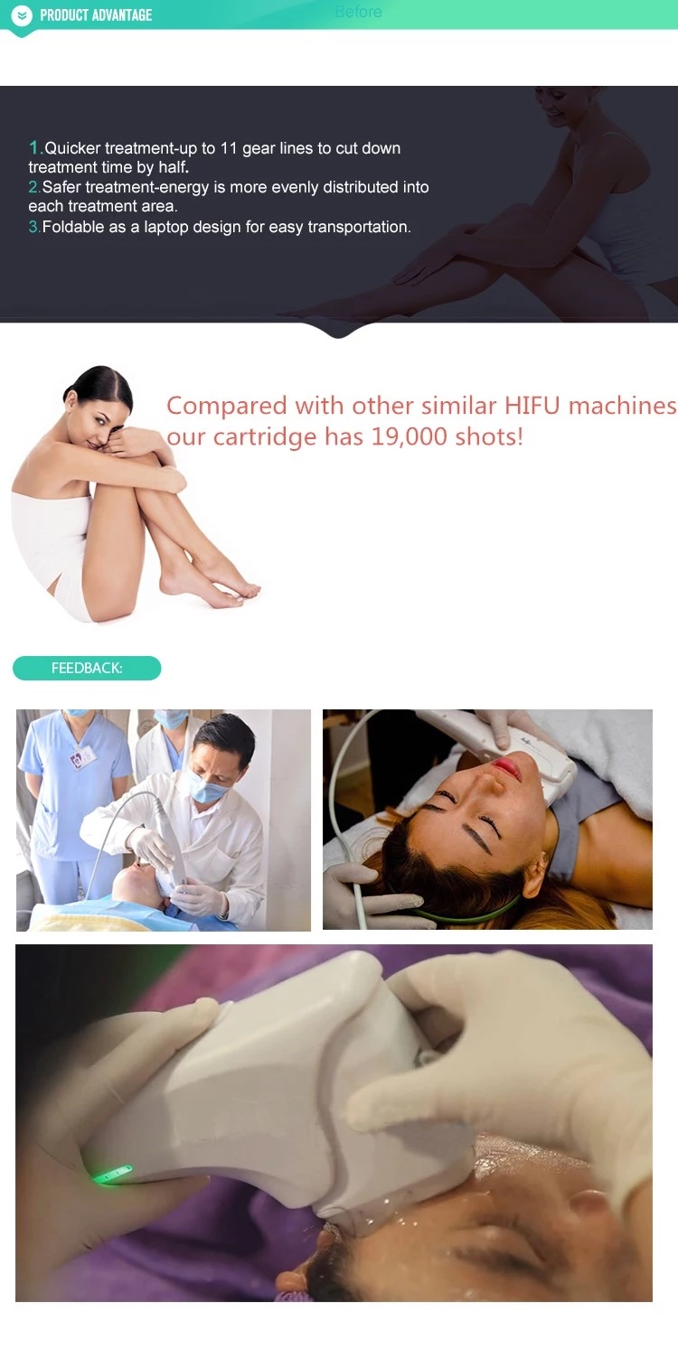 Skin tightening HIFU lifting 3d machine/11 lines 3d hifu face wrinkle removal for sale