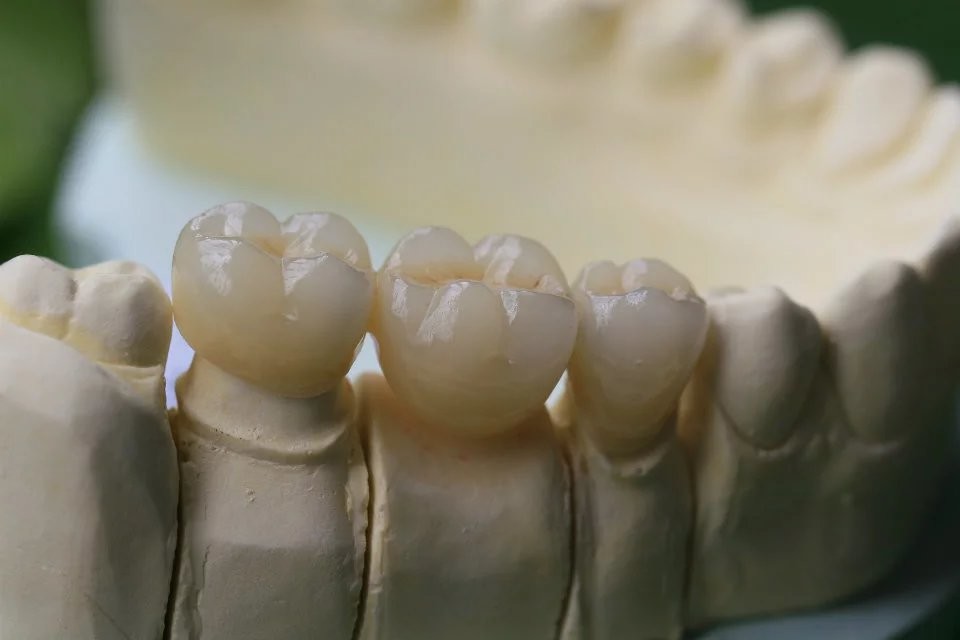 Dental Lab Fixed Prosthetics Layered Zirconia Dental Crown For Front Teeth