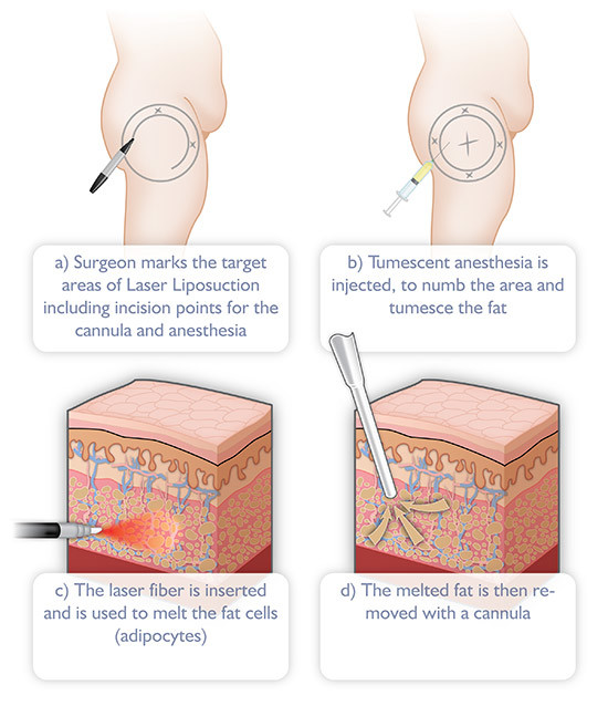 Plastic Surgery Laser Lipolysis Machine Equipment Aesthetic Diode Laser