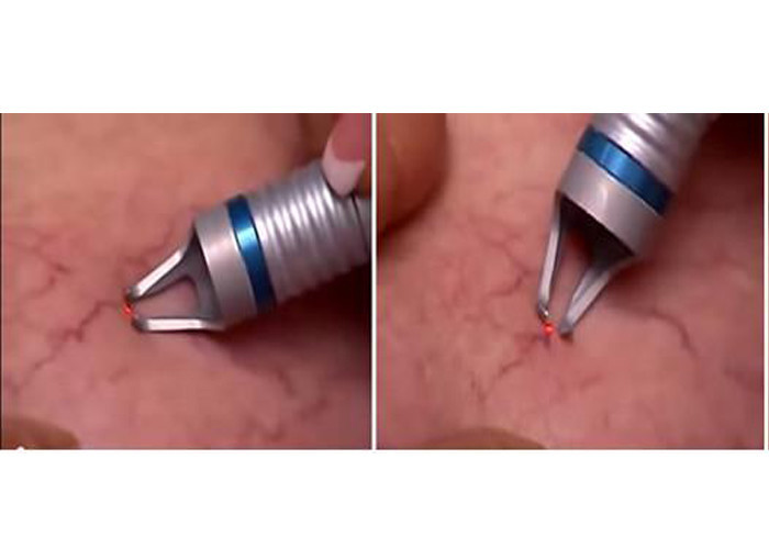 Repeat Pulse Laser Surgery Equipment 2mm Penetration 940nm