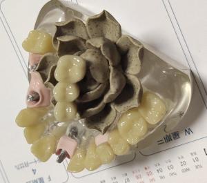 China 100 Percent Biocompatibility PMMA Provisional Crown wholesale