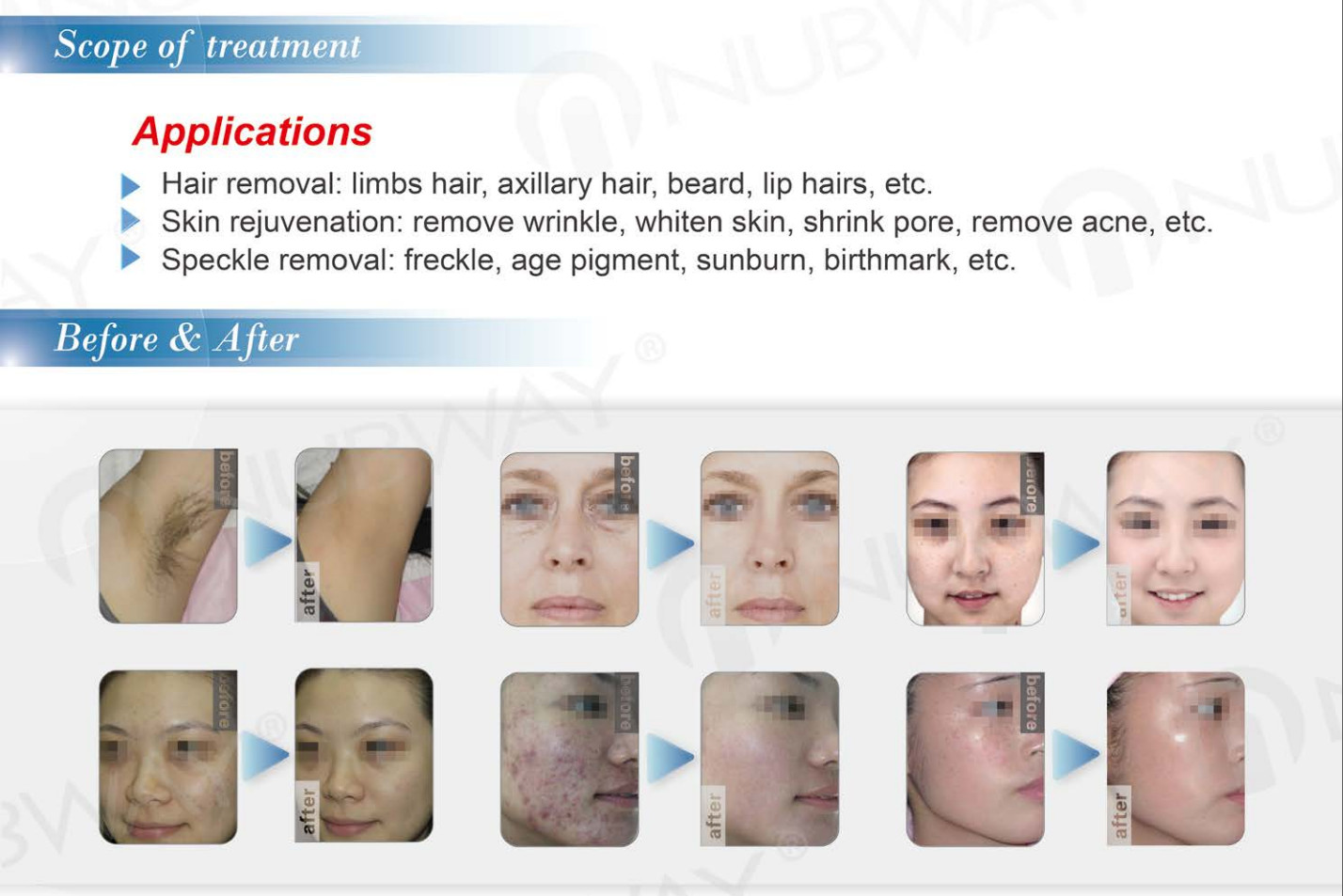 ipl flash lamp hair removal price ipl laser hair removal machine