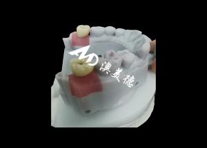 China Dental Implant Crown with titanium abutment for Durable Tooth Restoration wholesale