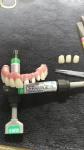 Resin-Based CAD-CAM Fixed Removable Bridge Aesthetics Restoration