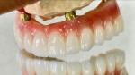 Dental All On X Implant PFM Crown Titanium Fixed Hybrid Denture