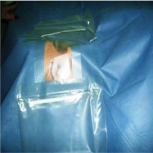 China Ophthalmology Multiple Layer Sterile Surgical Drapes With Pouch wholesale