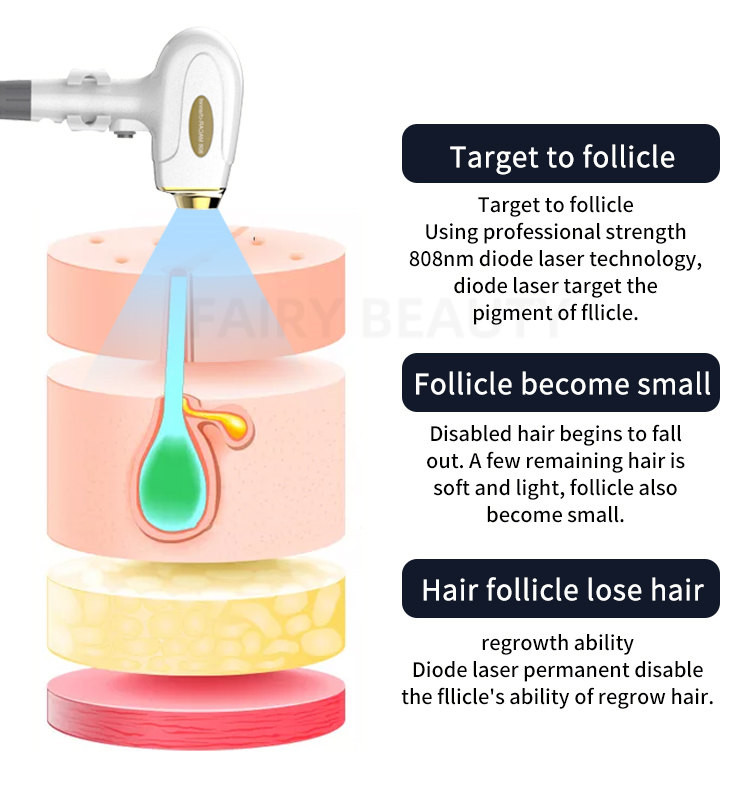 755nm Triple Wavelength Laser Hair Removal 808nm 1064nm