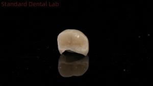 China Translucency Dental Zirconia Crown Inlay Onlay Crown For Restore Natural Cavity Shape wholesale