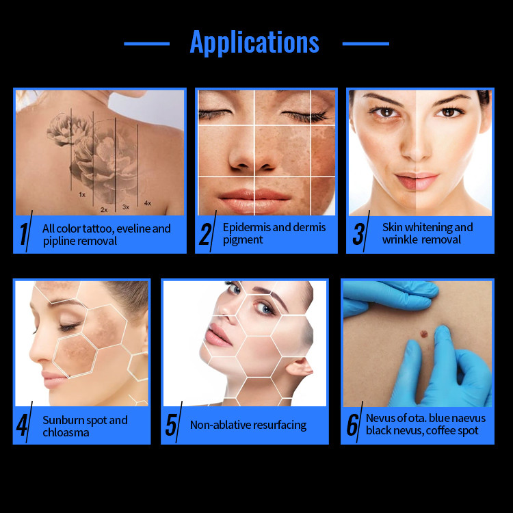 Touch Screen Control System Q Switched Nd Yag Laser for Vascular Lesion Treatment